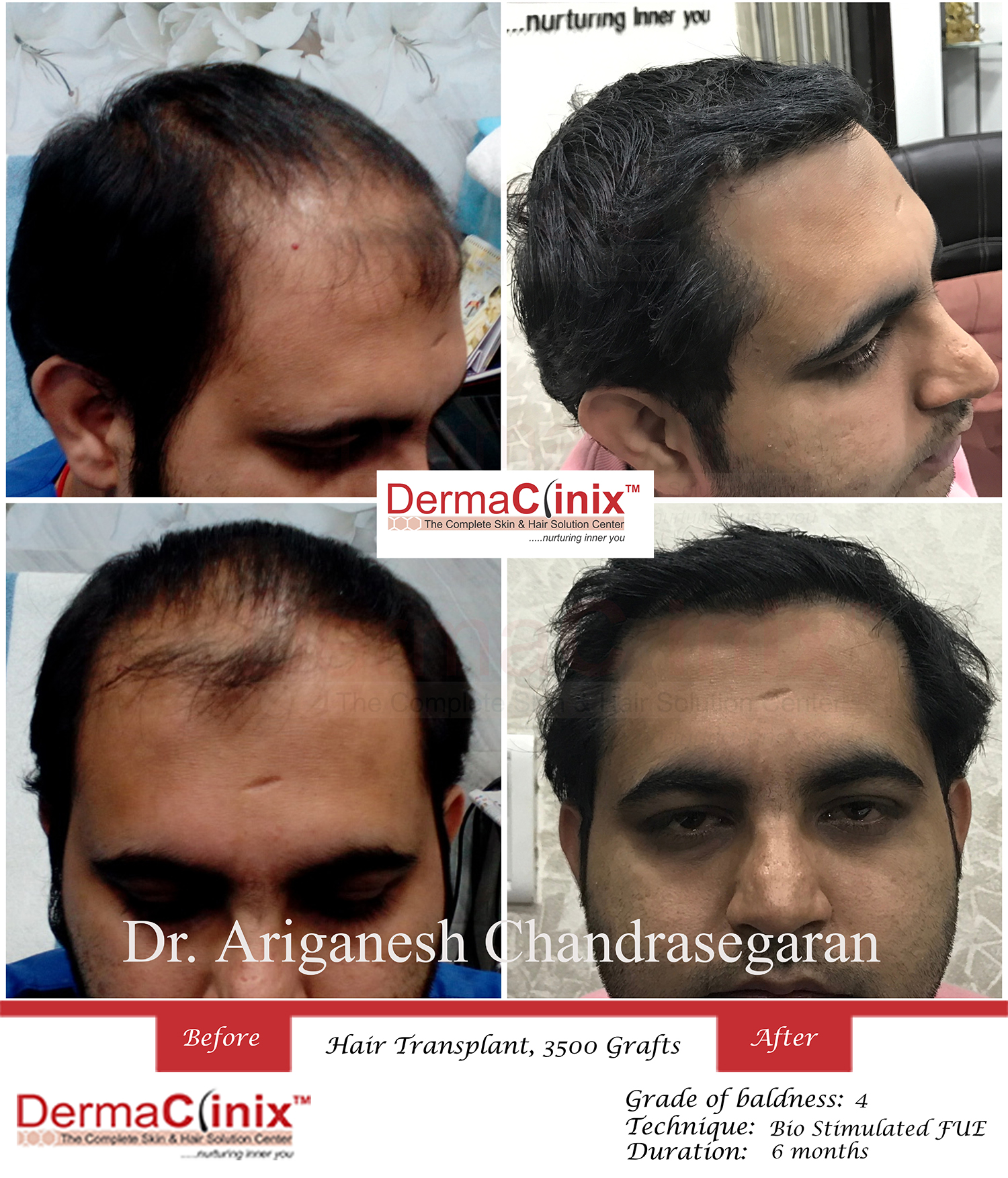 Best Hair Transplant Clinic in Chennai, Hair Restoration Center Chennai